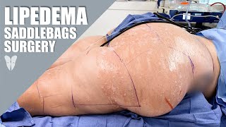 Lipedema Reduction Surgery: Thighs \u0026 Buttocks | Total Lipedema Care