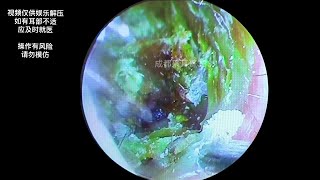 采耳哥-Cleaning of cholesteatoma of external auditory canal | 333