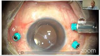 AIOC2021-IC569-Topic-Dr.Deependra V Singh (Handling High myopic eyes)