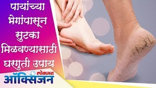 पायांच्या भेगांपासून सुटका मिळवण्यासाठी घरगुती उपाय Remove Cracked Heels Home Remedy | Lokmat Oxygen