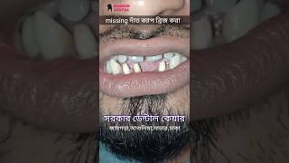 রুট ক্যানেল চিকিৎসা ও দাঁতের ক্যাপ লাগানো || Root canal treatment | Dental crowns #ytshorts #shorts