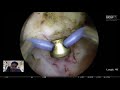 bipolar anatomical endoscopic enucleation of prostate 150 gr unedited full operation