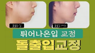 치아 돌출입교정 튀어나온입술 얼굴의 변화