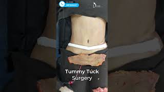 Tummy Tuck Surgery | Immediate Before and After Results #shortsfeed
