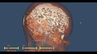 VTK Brain Reconstruction