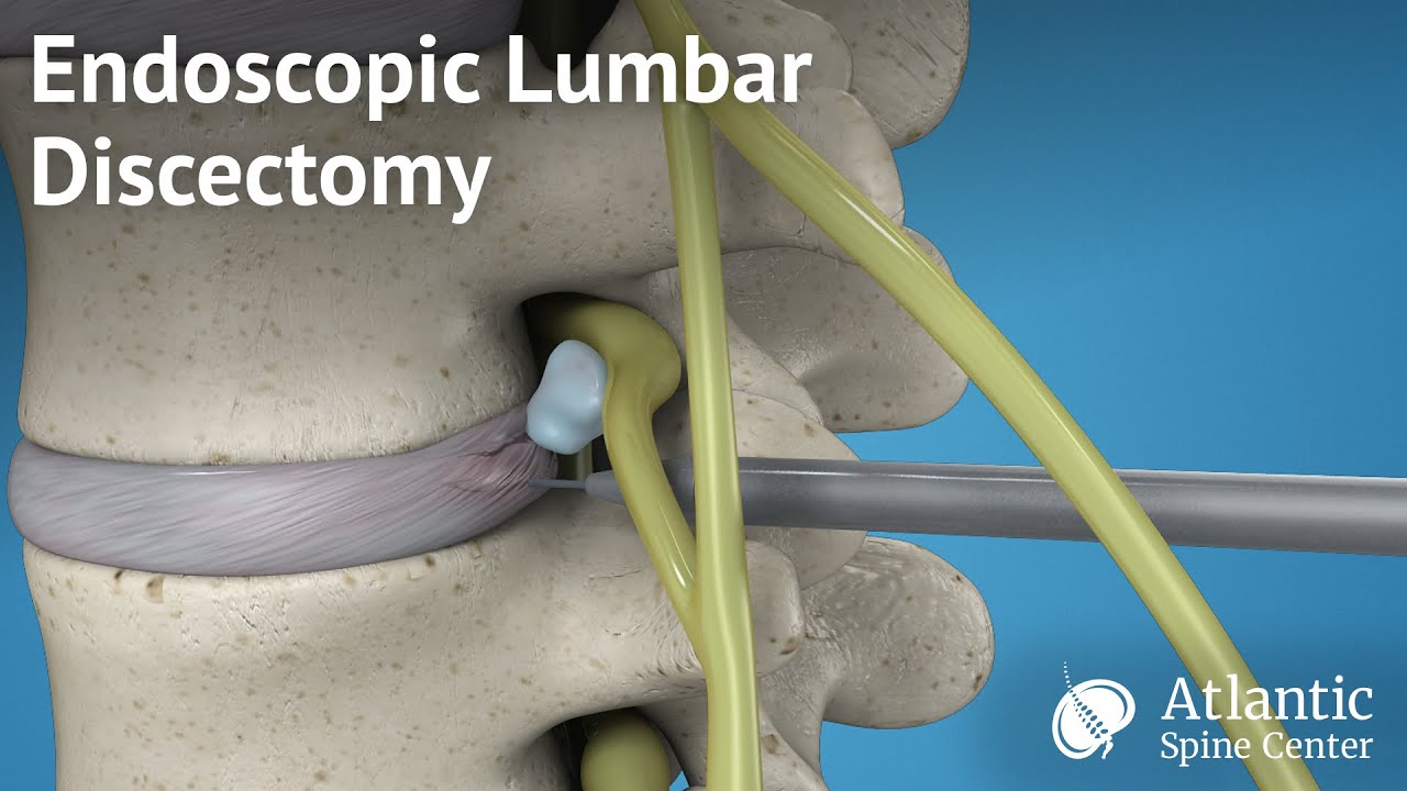 Endoscopic Lumbar Discectomy Youtube