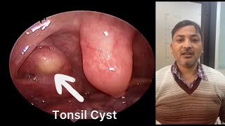 Right Tonsil Cyst - गले में दर्द और टीस का कारण?