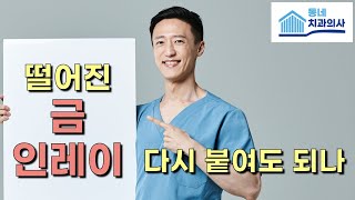 떨어진 금 인레이는 다시 붙여도 될까? feat. 비양심 치과 거르는 팁