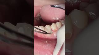 Anterior teeth deep cavities root canal treatment and composite #dentist t