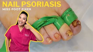 Nail Psoriasis: WHAT TO DO?