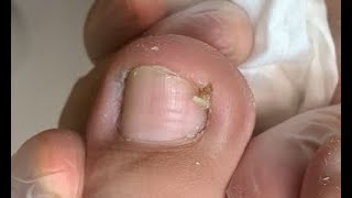 Nails stuck in toes and need to be cleaned