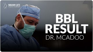 Dr.McAdoo - BBL RESULT- MiamiLife Plastic Surgery