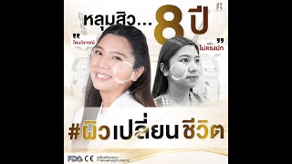 #ผิวเปลี่ยนชีวิต บอกลาหลุมสิว 8 ปี… เปลี่ยนชีวิตจากผิวคนธรรมดา สู่ผิวใหม่ในเวอร์ชั่นที่ดีกว่า ✨