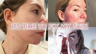 ITS TIME TO FIX MY SKIN | MY ACNE AND SCARRING JOURNEY