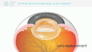 What are intra-ocular lenses, or lens implants?