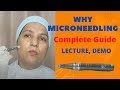 Microneedling Live Demo