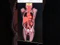 whole body pet scan positron emission tomography