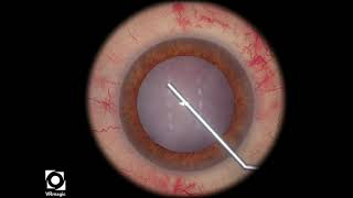 EyeSi CAT D Capsulorhexis White Cataract, High Capsular Tension, Weak Zonules