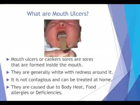10 Home Remedies for Mouth Ulcer in Kids 10 Home Remedies for Mouth Ulcer in Kids