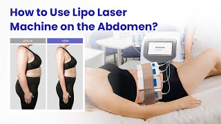 The Ultimate Guide to Abdominal Lipo Laser Magic! Model: WL-UU1401