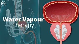 Water Vapour Therapy | Benign Prostatic Hyperplasia (BPH)