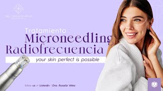 Scarlet S | Tratamiento de Radiofrecuencia + Microneedling