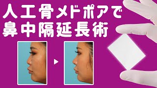 【鼻整形】術式の進化！人工骨メドポアを使った鼻中隔延長術｜ヴェリテクリニック