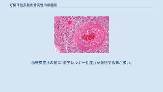 好酸球性多発血管炎性肉芽腫症