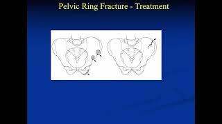 20  Pediatric Pelvic and Acetabular Fractures   Nirav Pandya, MD