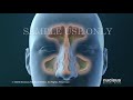 Sinusitis Surgery