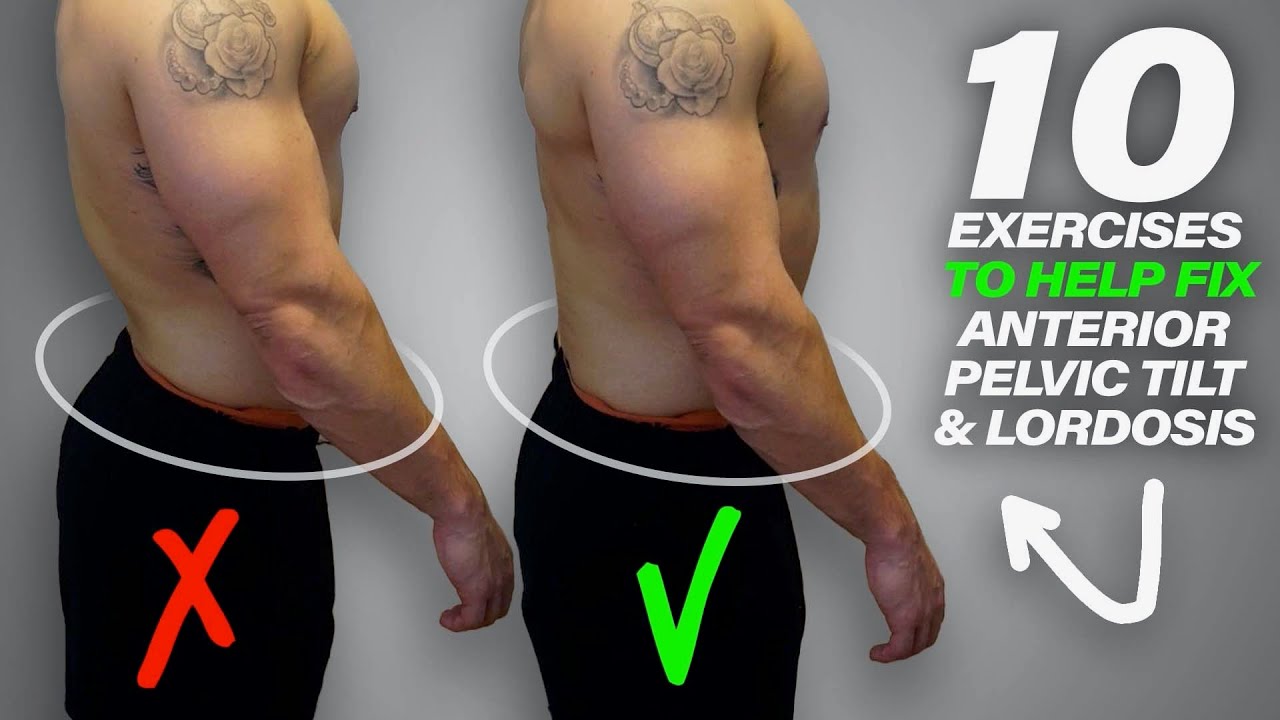 Lordosis Treatment Before After