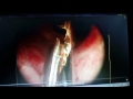 endocervical adenocarcinoma hysteroscopic biopsy