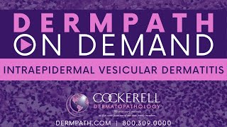 Intraepidermal Vesicular Dermatitis