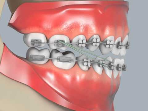 Class III Elastics - Lateral View - YouTube