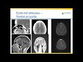 CNS Infections ---- Neuroradiology Brain Imaging Lecture