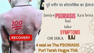 Pura Sharir  ka PSORIASIS hua khtam 100% RECOVERY #PSORIASIS  Psoriasis Treatment Ghar Baithy Ilaj