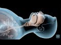 Sleep Apnea verses Snoring | Match Health