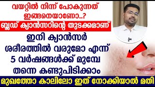 ഇനി ക്യാൻസർ വരുമോ എന്ന് 5 വർഷങ്ങൾക്ക് മുമ്പേ തന്നെ കണ്ടുപിടിക്കാം മുഖത്തോ കാലിലോ ഇത് നോക്കിയാൽ മതി