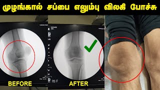 முழங்கால் சப்பை எலும்பு விலகல் சிகிச்சை ! Patella Dislocation Treatment ! #kneecap #kneejoint