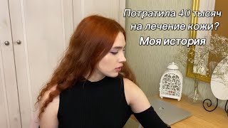 Потратила 40 тысяч на лечение акне | Роаккутан | Моя история