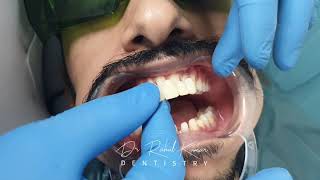 SMILE DESIGN LESS THAN 3 HOURS  - SAME DAY FIXED TEETH