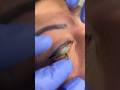 Could you handle this eyeliner tattoo removal? #shorts #dermatologist