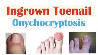 Ingrown Toenail (Onychocryptosis) | Causes, Risk Factors, Signs \u0026 Symptoms, Diagnosis, Treatment