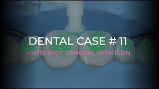 DENTAL CASE #11 | WHITE SPOT REMOVAL WITH ICON