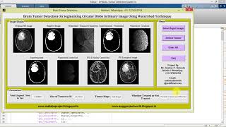 Brain Tumor Detection Using Watershed Technique Matlab Code