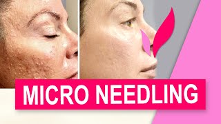 മുഖം മിനുക്കാൻ മൈക്രോ നീഡ്‌ലിങ്  | Micro needling | Dr Vimi