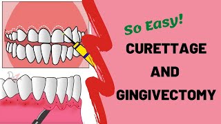 How is Curettage Done?