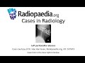 Left peritonsillar abscess (Radiopaedia.org) Cases in Radiology