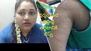 చర్మం మీద వచ్చే దద్దుర్లు తగ్గించడానికి టిప్స్.