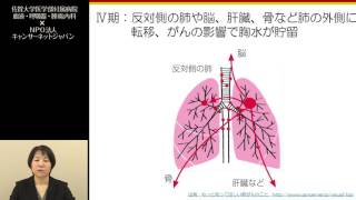非小細胞肺がんについて 中村 朝美